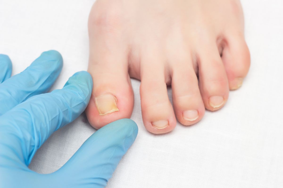 In-grown Toenail Management