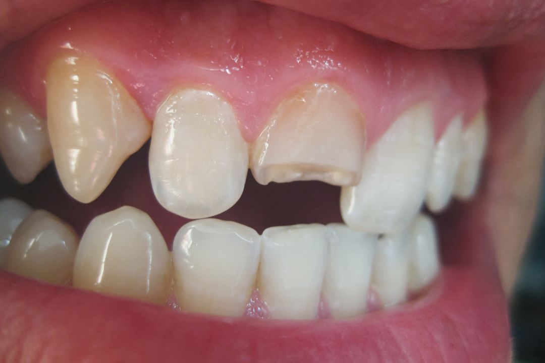 Chipped or Broken Teeth before and after veneers