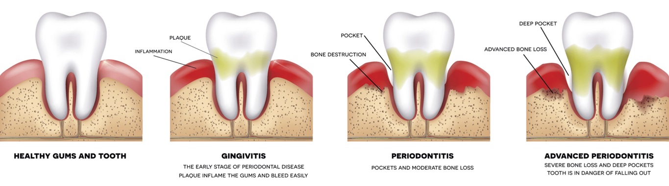 Gum Disease Progression