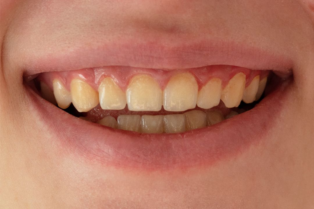 Severe Staining before and after veneers