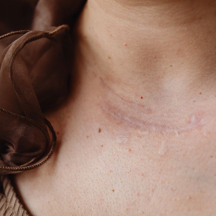 Comprehensive Scar Treatment