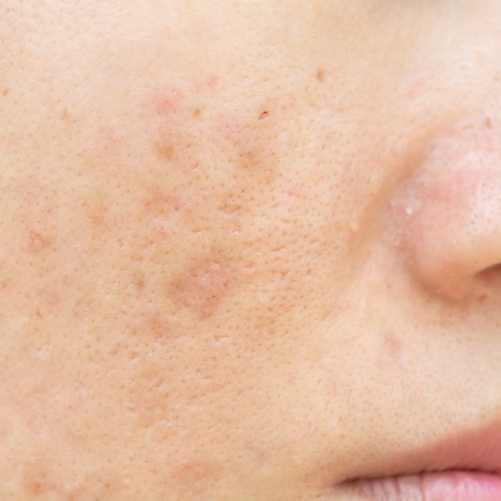 Overall Skin Spot Treatment