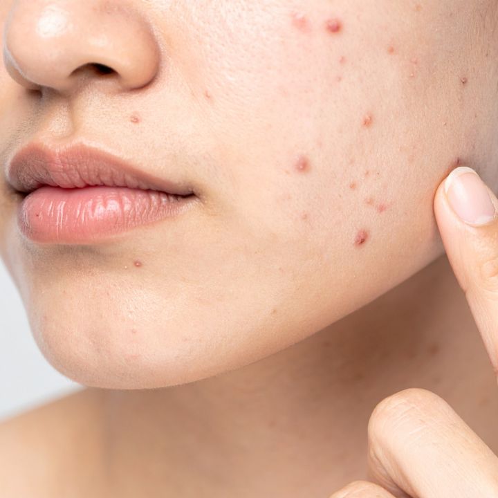 Pimple Marks Treatment