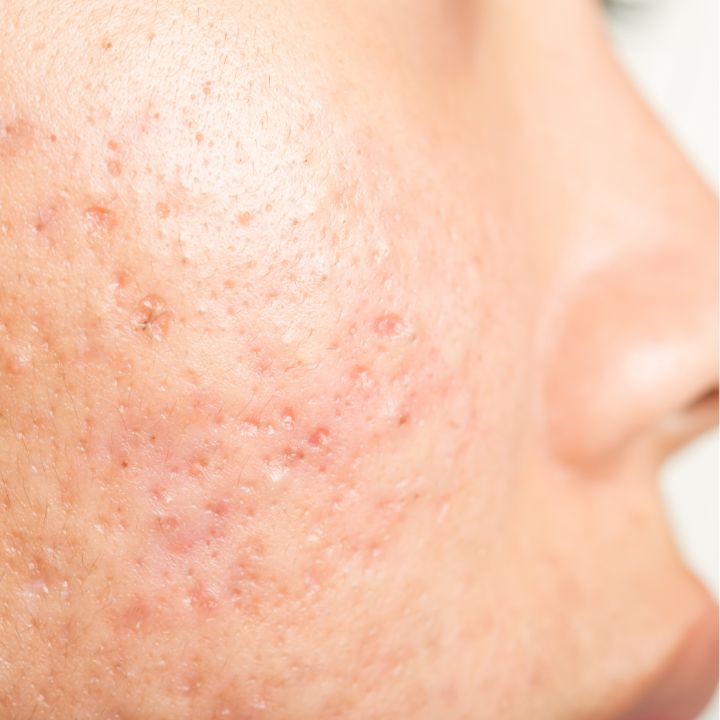 Pimple Scar Treatment