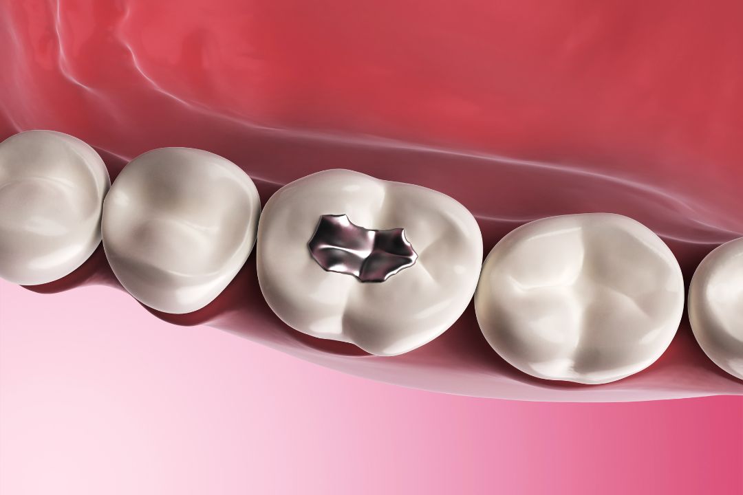 Cavity Fillings
