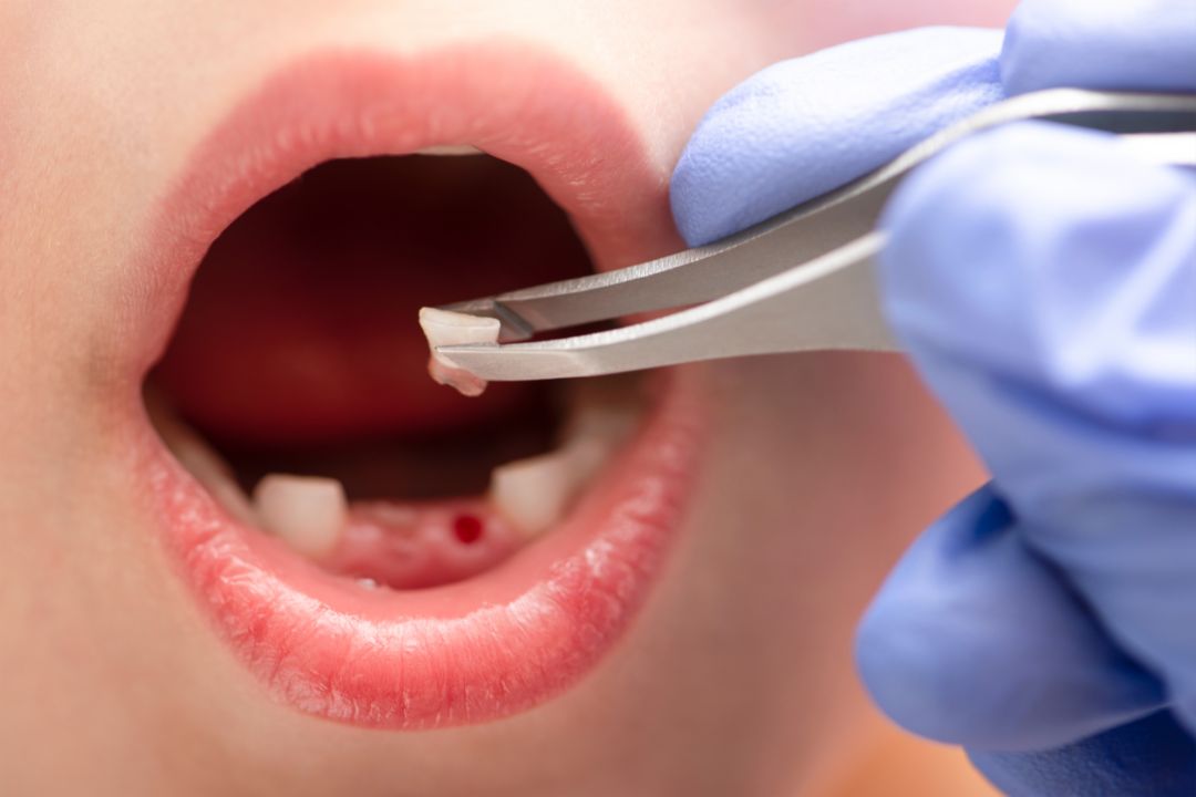 Tooth Extractions