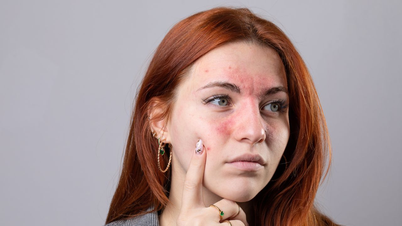 Rosacea Relief Skin Treatment