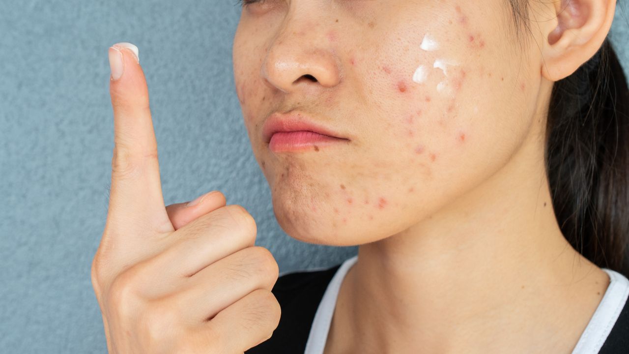 Summer Acne Skin Treatment