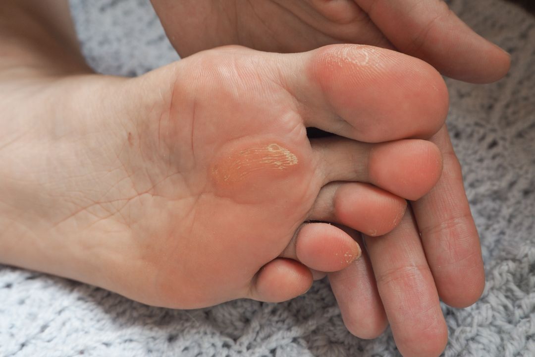Corns and Callus Removal in Dubai