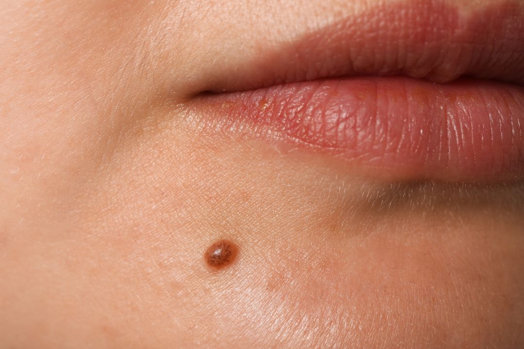 Moles Removal in Dubai