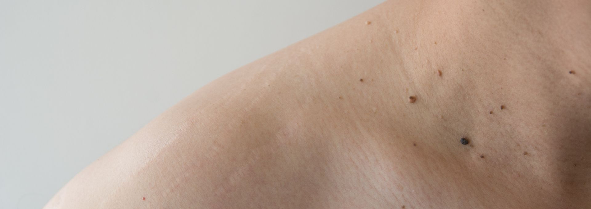 Moles and Skin Tags Removal Dubai