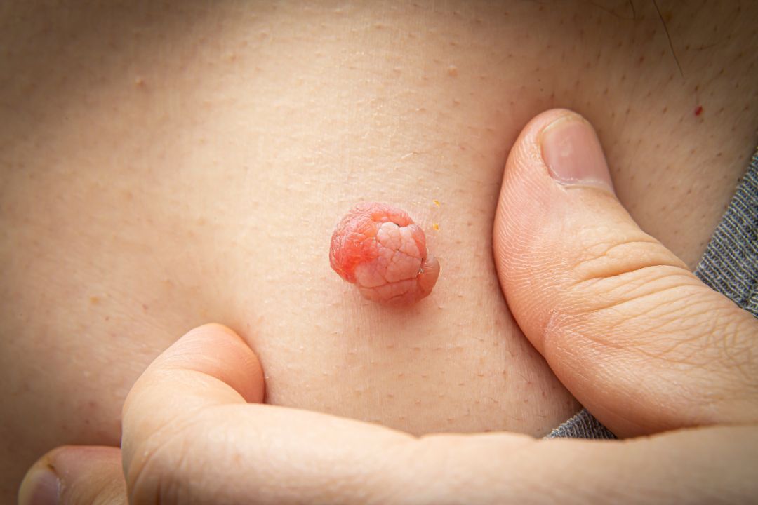 Skin Tags Removal in Dubai