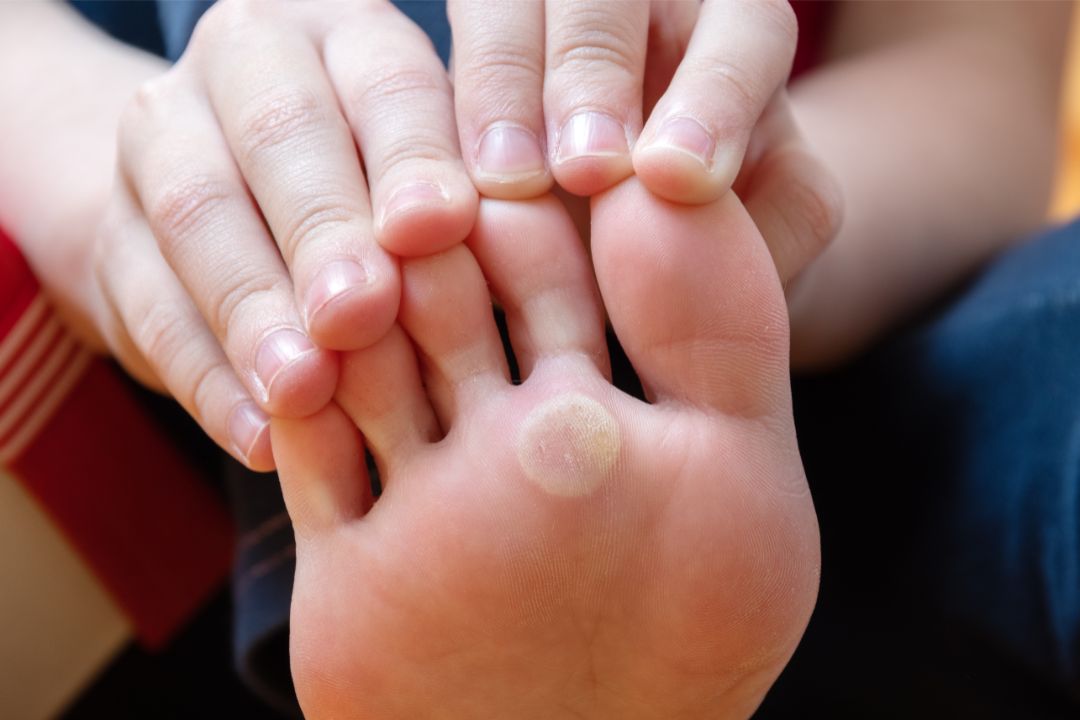Warts Removal in Dubai