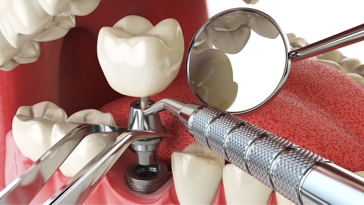 Dental Implant Procedure in Dubai