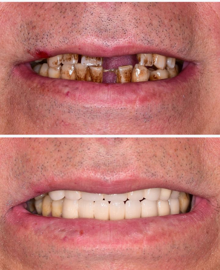 Dental Implants Before and After Case 1