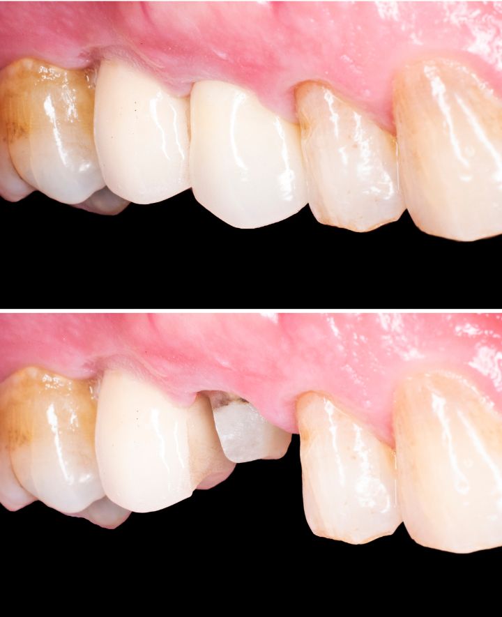 Dental Implants Before and After Case 2