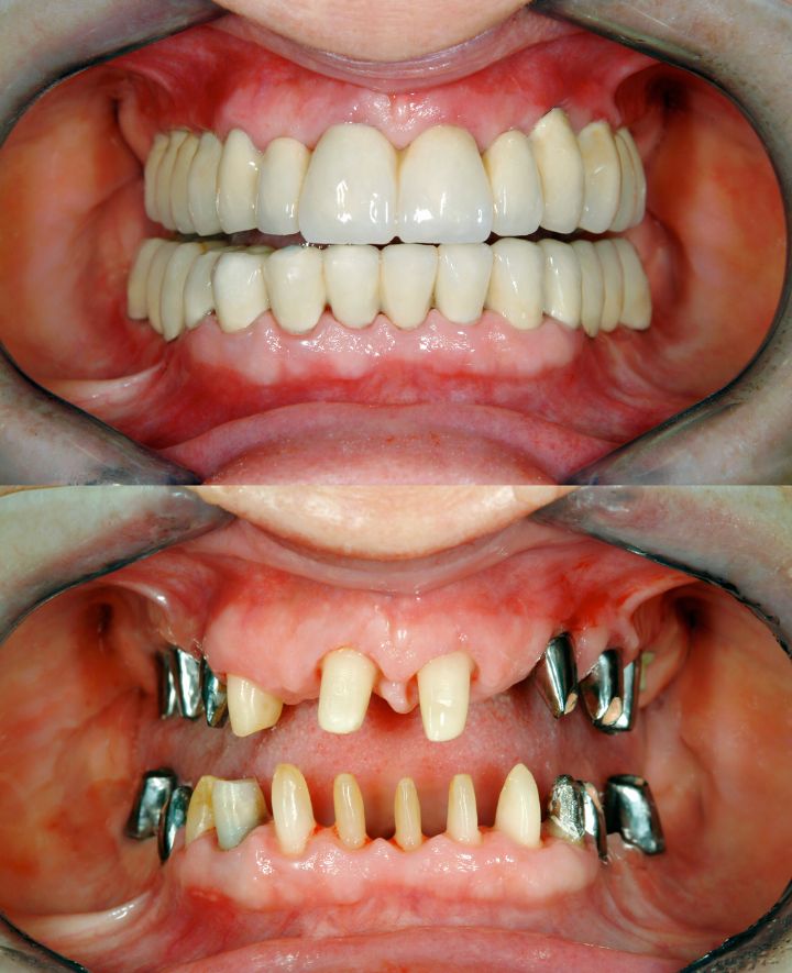 Dental Implants Before and After Case 3