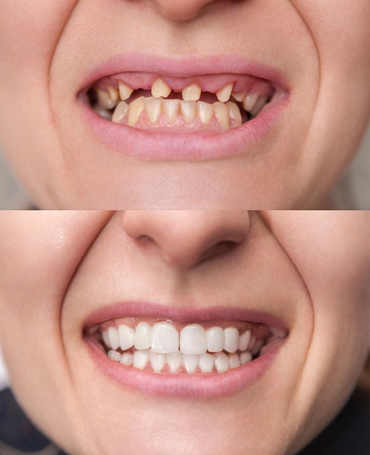 Dental Implants Before and After Case 4