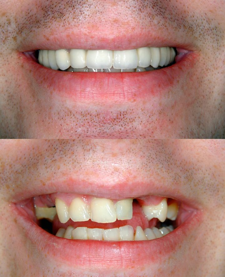 Dental Implants Before and After Case 5