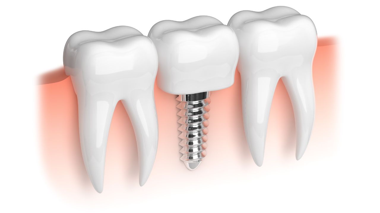Dental Implants in Dubai