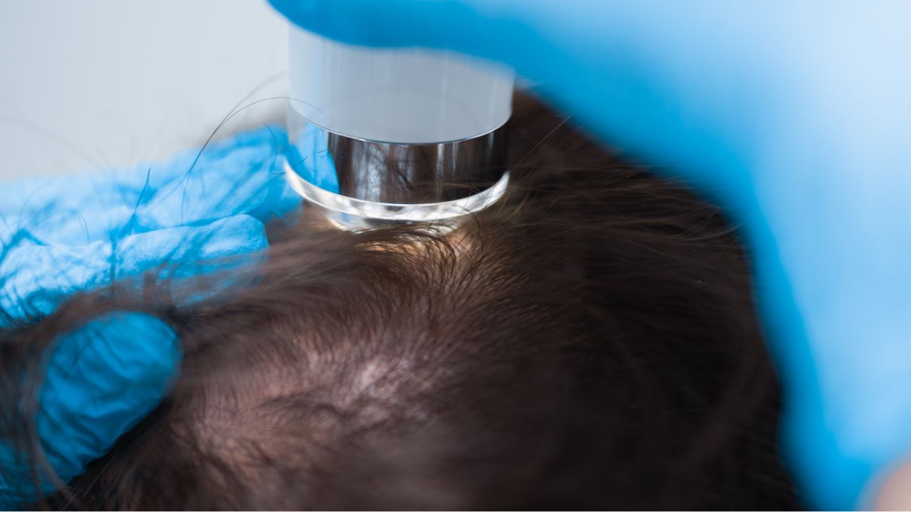 Hair Exosome Treatment in Dubai