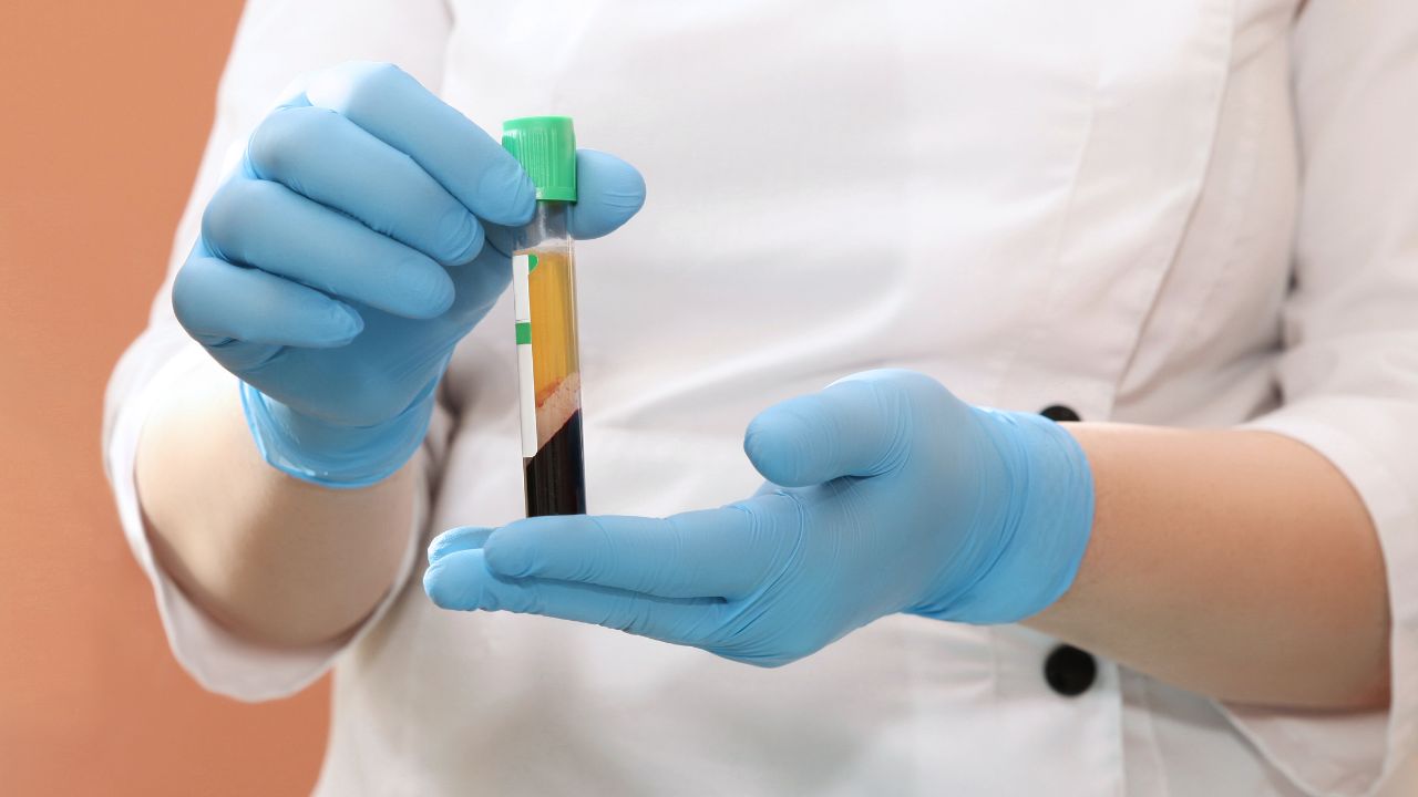 PRP Treatment in Dubai