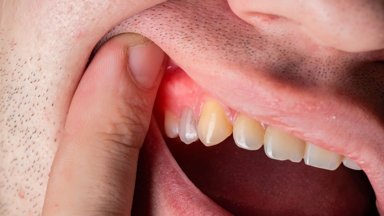 Signs You May Have Gum Disease