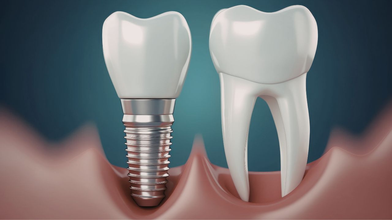 The Complete Guide to Dental Implants