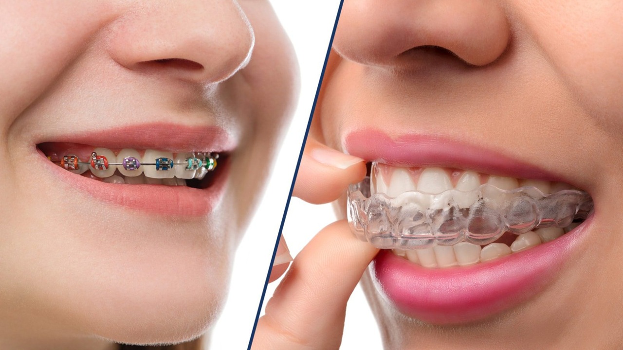 Clear Aligners vs Braces